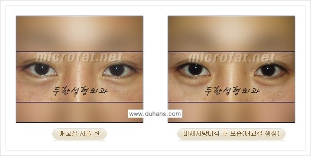 [두한성형외과 경쟁력 눈밑성형] - [애교살과 다크써클과의 관계] 관련 이미지 6