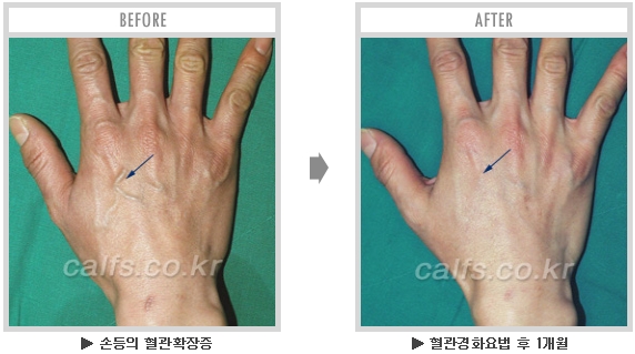 [종아리성형 두한성형외과] - [종아리수술에 대한 자주하는 질문과 답변 모음] 관련 이미지 38