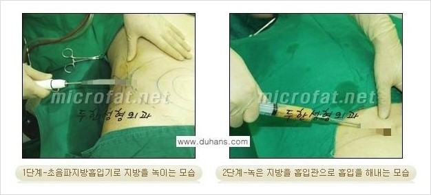 [두한성형외과 경쟁력 바디성형] - [하복부, 팔뚝, 허리선, 허벅지, 엉덩이 간편지방흡입술] 관련 이미지 8