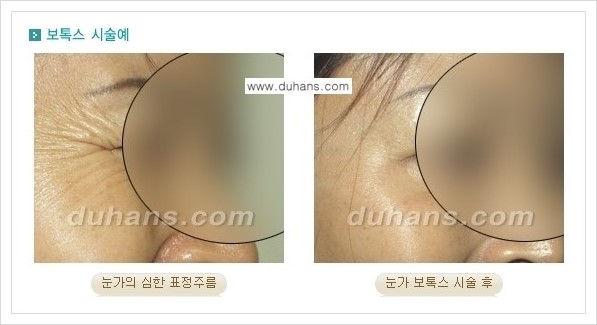 [두한성형외과 경쟁력 주름교정] - [간단 주사요법 - 보톡스 시술 안내 ②] 관련 이미지 2