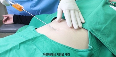 [두한성형외과 다크서클] - [다크서클 콜펫지방이식] 관련 이미지 7