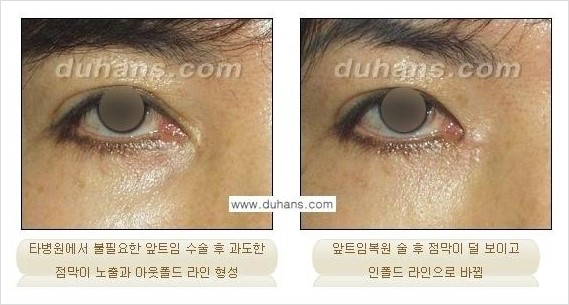[두한성형외과 경쟁력 눈성형] - [흉터없는 몽고주름 제거 - 앞트임 수술] 관련 이미지 15