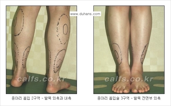 [두한성형외과 경쟁력 종아리성형] - [종아리 지방흡입 1.] 관련 이미지 4