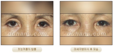 [Duhan Plastic Surgery Micro Fat Grafting] - [Upper Eyelids] image 11
