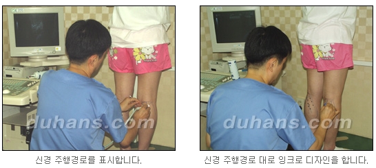 [두한성형외과 종아리축소술] - [초음파 유도 선택적 신경차단술 안내] 관련 이미지 8