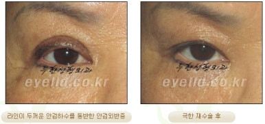 Duhan Plastic Surgery Ophthalmic Reoperation - What Is a Successful Double Eyelid Revision Surgery? image 13
