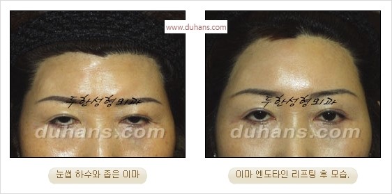 [두한성형외과 경쟁력 주름성형] - [간단하고 부작용 없는 자연스러운 주름제거 방법] 관련 이미지 15