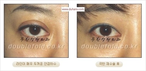 ​[두한성형외과 눈재수술] - [앞트임복원, 뒤트임복원, 쌍꺼풀복원] 관련 이미지 32