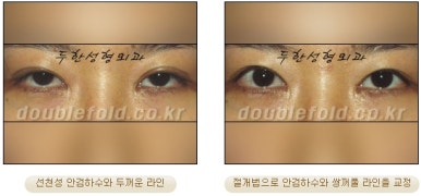 [Duhan Plastic Surgery Double Eyelid Revision Surgery] - [Ptosis, sausage eyelids] image 16