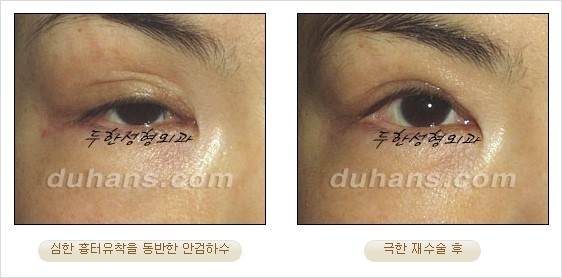 [두한성형외과 경쟁력 쌍꺼풀 재수술 리더 ] - [쌍꺼풀 재수술 과정, 쌍꺼풀 재수술 실패의 원인, 극한 재수술] 관련 이미지 17