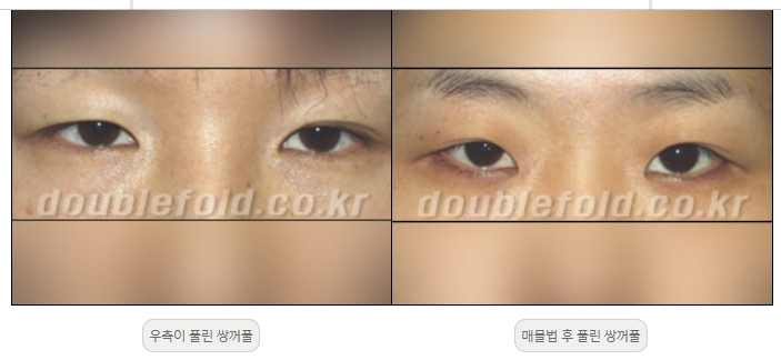 [두한성형외과 쌍커풀재수술] - [풀린 쌍커풀라인 교정] 관련 이미지 4