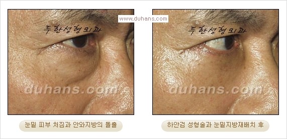 [두한성형외과 경쟁력 다크써클 교정] - [젊어 보이면서 개선된 인상을 주는 하안검 성형술] 관련 이미지 16