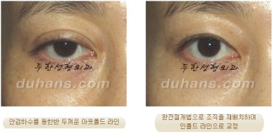 두한성형외과 눈재수술 - 쌍꺼풀 재수술 방법 관련 이미지 23