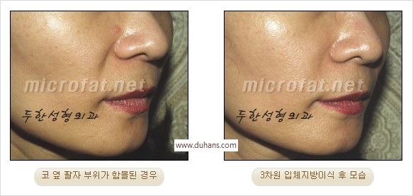 [두한성형외과 경쟁력 미세지방이식] - [귀족수술 입체 미세지방이식] 관련 이미지 11