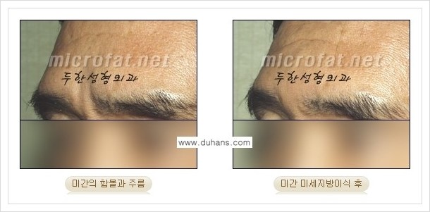⁠[두한성형외과 경쟁력 미세지방이식] - [상표등록 "Col-fat(콜펫) 지방이식"으로 교정이 가능한 부위] 관련 이미지 5