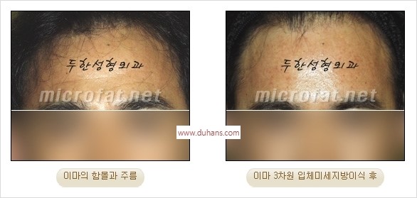 [두한성형외과 경쟁력 지방이식] - [두한 자가지방이식 클리닉 안내]​ 관련 이미지 34