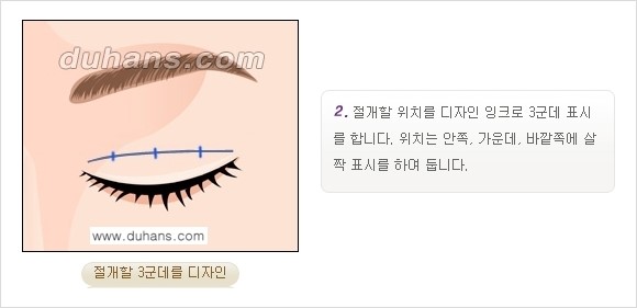 [두한성형외과 경쟁력 눈성형] - [쌍꺼풀 재수술 방법 - 부분절개법(Partial incision method) 과정 안내] 관련 이미지 3