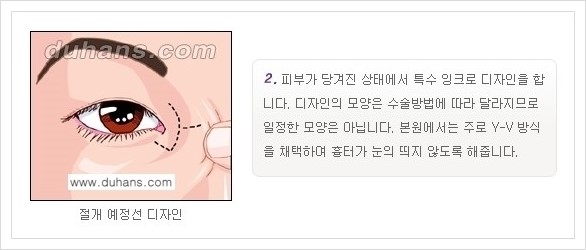 [두한성형외과 경쟁력 눈성형] - [앞트임 수술(몽고주름 제거) 안내 ②] 관련 이미지 2