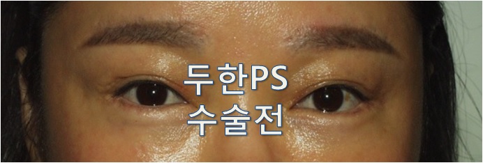 [두한ps]-#쌍꺼풀 재수술로 흉터 개선 &여러겹 쌍꺼풀 라인 개선 관련 이미지 1