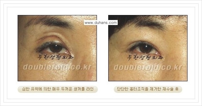 [두한성형외과 경쟁력 쌍꺼풀 재수술, 극한 재수술] - [여러번의 재수술로 인해 흉살이 두터운 경우 교정 방법 안내] 관련 이미지 2