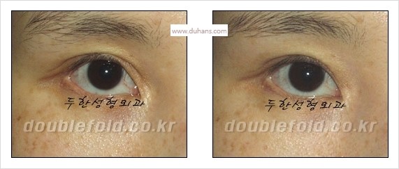 [두한성형외과 경쟁력 눈성형] - [쌍꺼풀 재수술 실패의 원인과 문제점] 관련 이미지 7