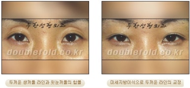 [두한성형외과 쌍커풀수술] - [쌍꺼풀지방이식] 관련 이미지 15