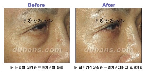 [두한성형외과 경쟁력 동안성형 리더] - ​[미간주름, 이마주름, 안검성형, 이마거상술, 눈썹거상술] 관련 이미지 80