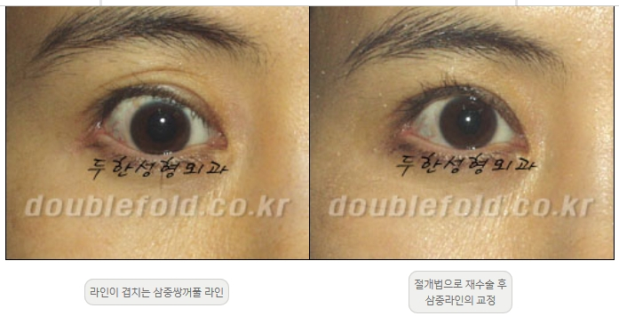 [Double Eyelid Surgery Duhan Plastic Surgery] - [Revision Methods] image 19