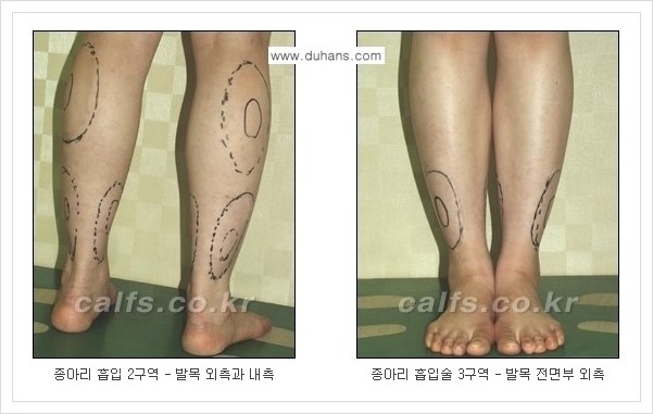 [두한성형외과 경쟁력 멀티종아리성형] - [예쁜 종아리를 만드는 종아리 지방흡입술 안내] 관련 이미지 3