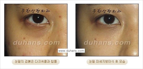[두한성형외과 상큼하고 환한 눈매완성] - [눈밑 미세지방이식 ②] 관련 이미지 15