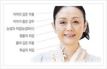 [두한성형외과 경쟁력 동안성형 리더] - ​[미간주름, 이마주름, 안검성형, 이마거상술, 눈썹거상술] 관련 이미지 124