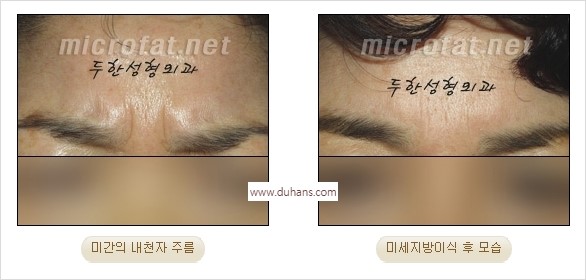 [두한성형외과 경쟁력 동안성형 리더] - ​[미간주름, 이마주름, 안검성형, 이마거상술, 눈썹거상술] 관련 이미지 19