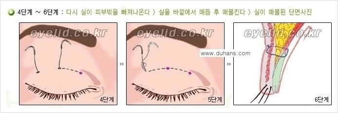 [두한성형외과 경쟁력 눈성형] - [절개법, 매몰법의 수술 방법] 관련 이미지 8