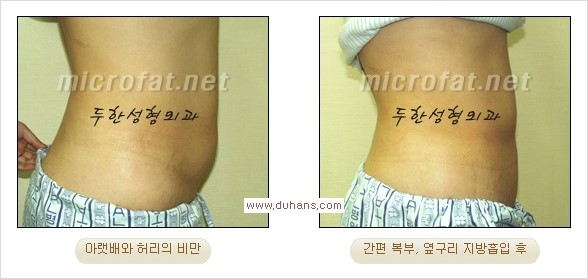 [두한성형외과 경쟁력 간편지방흡입] - [복부(뱃살) 비만 간편지방흡입] 관련 이미지 21
