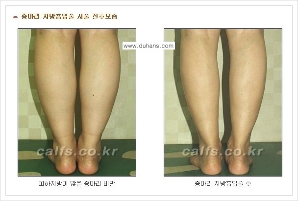 [두한성형외과 경쟁력 멀티종아리성형] - [나에게 맞는 종아리 시술 방법과 종류 안내 ②] 관련 이미지 7