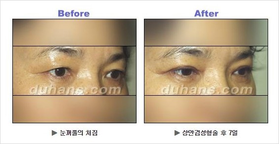 [두한성형외과 경쟁력 안검성형] - [상큼하고 환한 눈매의 완성 상안검 성형술 안내] 관련 이미지 11