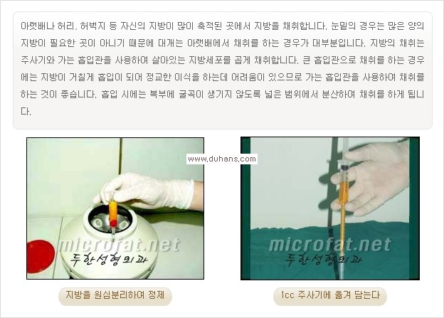 [두한성형외과 경쟁력 눈밑성형] - [눈밑 다크써클과 눈밑 애교살과의 관계] 관련 이미지 4