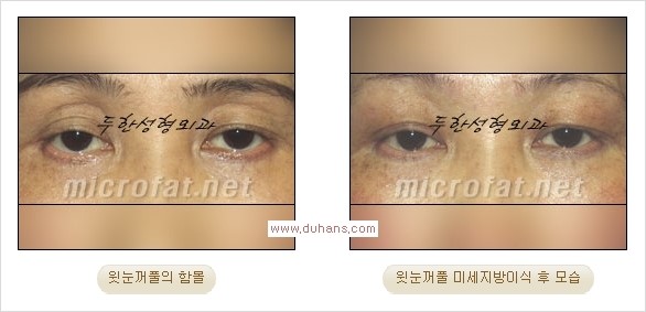 [두한성형외과 Dr. 컬럼] - [눈꺼풀의 지방이식] 관련 이미지 5