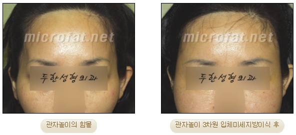 [두한성형외과 미세지방이식] - [자가지방이식] 관련 이미지 8