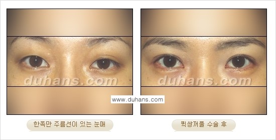 [두한성형외과 경쟁력 눈성형]- [최소 부기로 일상의로의 복귀가 가능한 아름다운 퀵쌍꺼풀(부분절개법) 수술] 관련 이미지 11