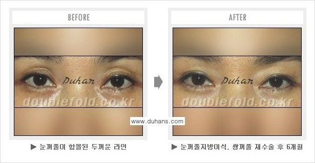 [두한성형외과 경쟁력 쌍꺼풀 재수술] - [과도한 앞트임이 되었을 경우 안내] 관련 이미지 6