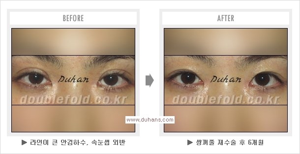 [두한성형외과 쌍꺼풀 재수술, 극한 눈재수술] - [재수술에 대한 자주하는 질문과 답변 안내] 관련 이미지 2