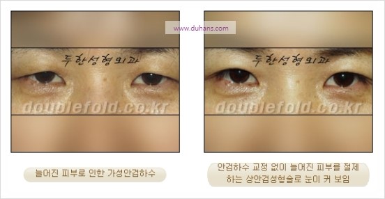 [두한성형외과 경쟁력 눈성형] - [극한 재수술, 함몰된 눈꺼풀 라인교정, 안검하수(졸리운 눈매)] 관련 이미지 89
