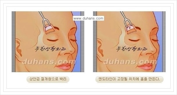 [두한성형외과 경쟁력 주름성형] - [회복과 일상으로의 복귀가 빠른 눈썹거상, 이마주름 엔도타인 리프팅] 관련 이미지 9