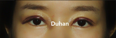 [Duhan Plastic Surgery Secondary Double Eyelid Surgery] - [Sleepy Eye Appearance, Asymmetrical Eye Appearance, Ptosis] image 2