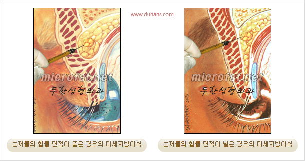 [두한성형외과 경쟁력 눈성형 리더] - [윗눈꺼풀 함몰( #꺼진눈꺼풀) 미세지방이식과 상안검성형]#꺼진눈성형 , #눈위함몰 관련 이미지 3