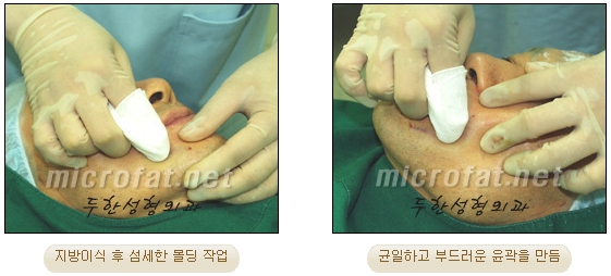 [Duhan Plastic Surgery Double Eyelid Revision Surgery] - [Correcting the Double Eyelid Line in Sunken Eyelids] image 58