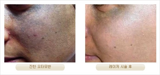[두한성형외과 경쟁력 안전성형] - [최첨단 장비를 이용한 흉터, 점, 주근깨, 잡티, 문신제거 레이저 시술] 관련 이미지 24