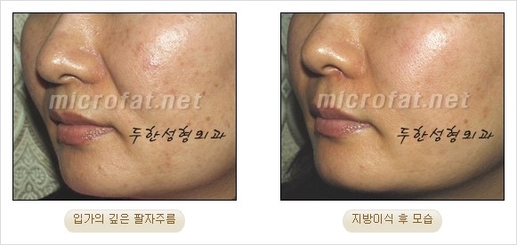 [두한성형외과 경쟁력 안티에이징 동안성형] - [주름이 깊은 푹~ 꺼진 입가 팔자주름 안녕!] 관련 이미지 15