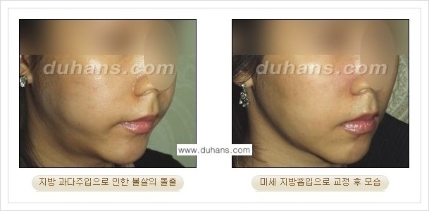[두한성형외과 경쟁력 얼굴 미세지방이식] - [타병원에서 지방이식 후 굴곡과 과주입 교정 안내] 관련 이미지 10